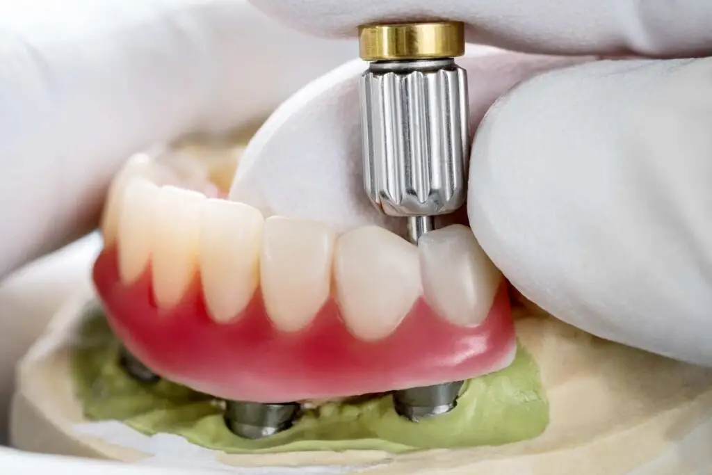 Implant dentures