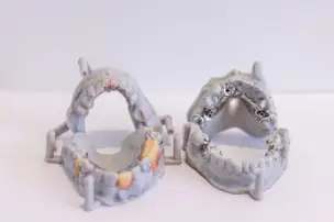 Two dental models showing upper and lower jaw implants and teeth alignment.