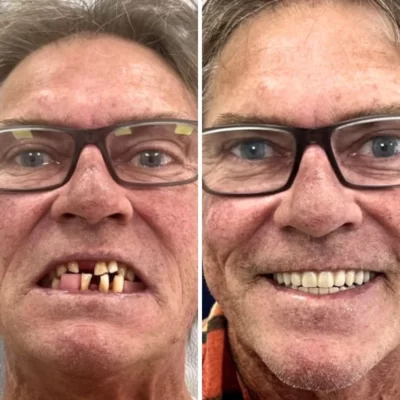 man before and after dentures