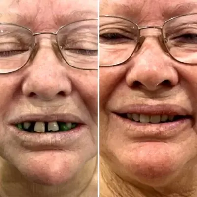 woman before and after dentures