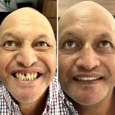 man before and after dentures