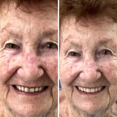 woman before and after dentures