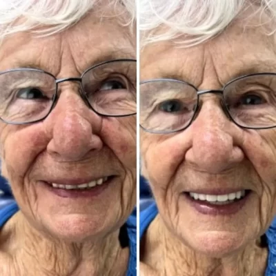 woman before and after dentures