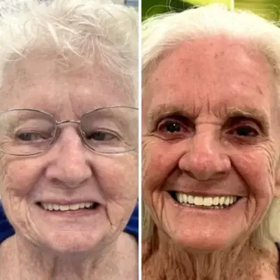 woman before and after dentures