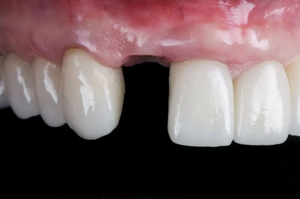 Close-up of upper front teeth and gums, highlighting how dentures can impact your speech.