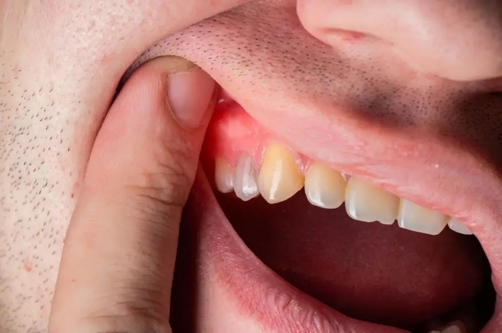 Person pulling back their lip to reveal swollen gums above partial dentures.