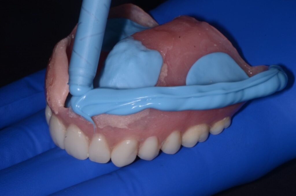 Dental impression material applied for emergency denture repair by a gloved hand.
