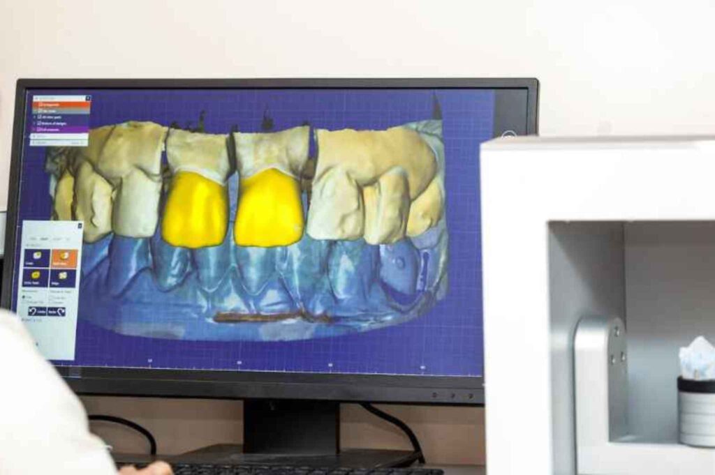 Computer screen displays a 3D dental model for denture manufacturing with two yellow teeth highlighted.